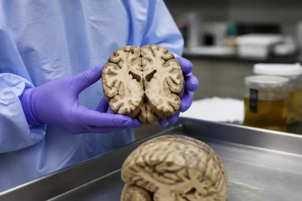 Onderzoek: ten minste één op de vier ex-NFL-spelers had CTE